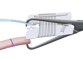 ACL FIBERTAG TIGHTROPE IMPLANT - 1 each